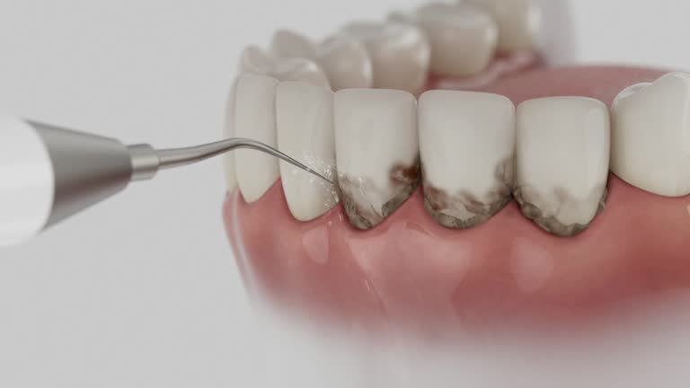 Trusted Wisdom Tooth Removal service in Youngsville, NC - Dentist Open Now